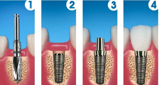 Model al unui implant dentar inserat în osul maxilar