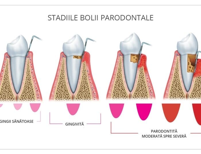 Ilustrație a structurilor parodontale — gingie, ligamente și os alveolar